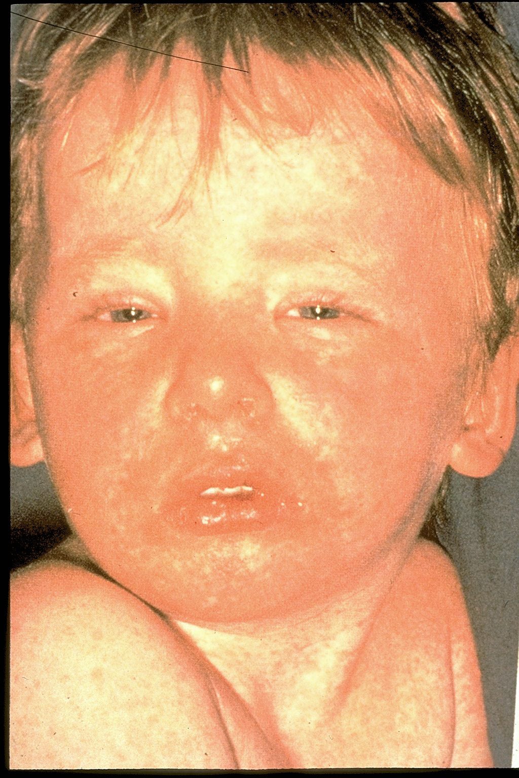 measles 1
