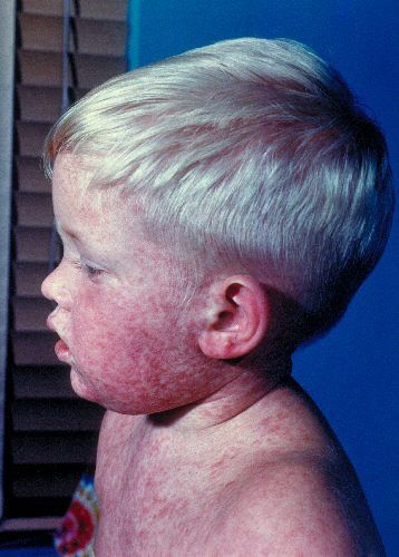 measles 8